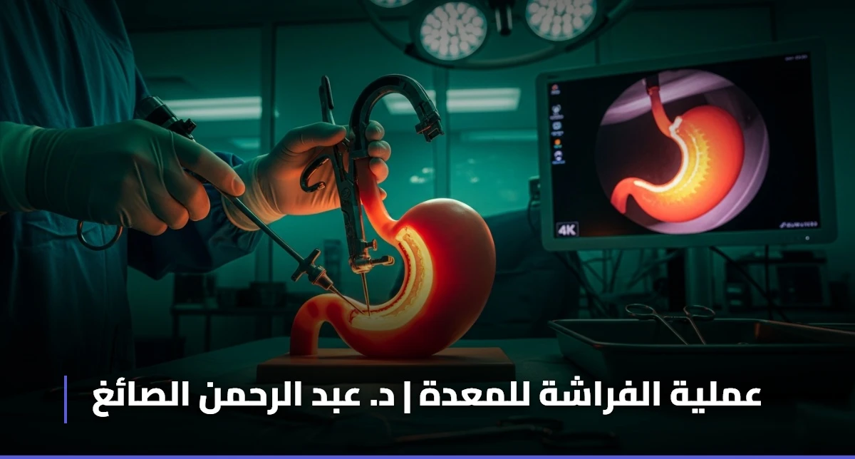 عملية الفراشة للمعدة