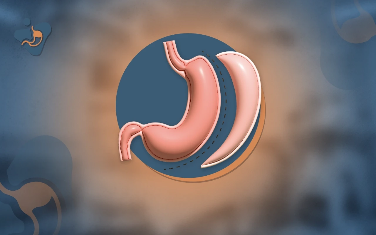 Dr. Alsaigh | تكميم المعدة مع د. عبدالرحمن الصايغ | جراحة السمنة بالمنظار