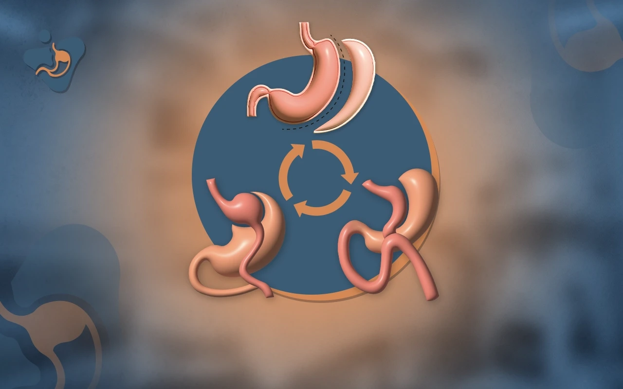 Dr. Alsaigh | عملية إعادة عمليات السمنة | الجراحة التصحيحية لاستعادة الوزن المثالي