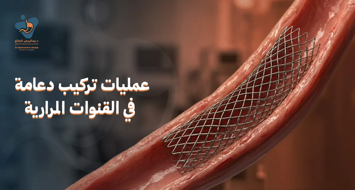 عمليات تركيب دعامة في القنوات المرارية: الأسباب والخطوات وأفضل الأطباء في الرياض