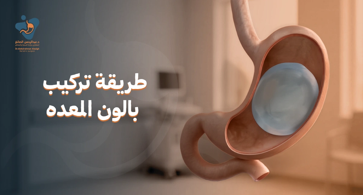 طريقة تركيب بالون المعده: دليلك الشامل لتحقيق الوزن المثالي مع الدكتور عبد الرحمن الصائغ