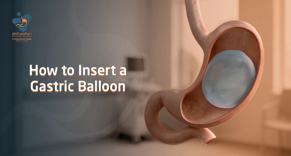 How to Insert a Gastric Balloon: Your Comprehensive Guide to Achieving the Ideal Weight with Dr. Abdulrahman Alsaigh